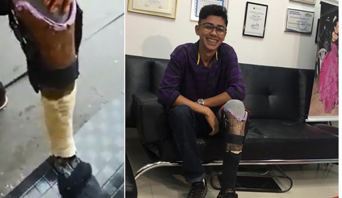 Jovem que tinha perna feita em casa ganha prótese após o seu vídeo viralizar