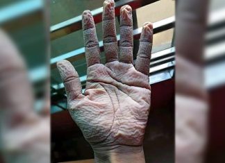 Médico choca ao mostrar a mão como sacrifício de trabalhar na linha de frente: 10 horas de luvas