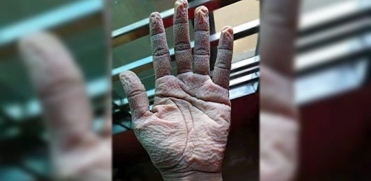 Médico choca ao mostrar a mão como sacrifício de trabalhar na linha de frente: 10 horas de luvas