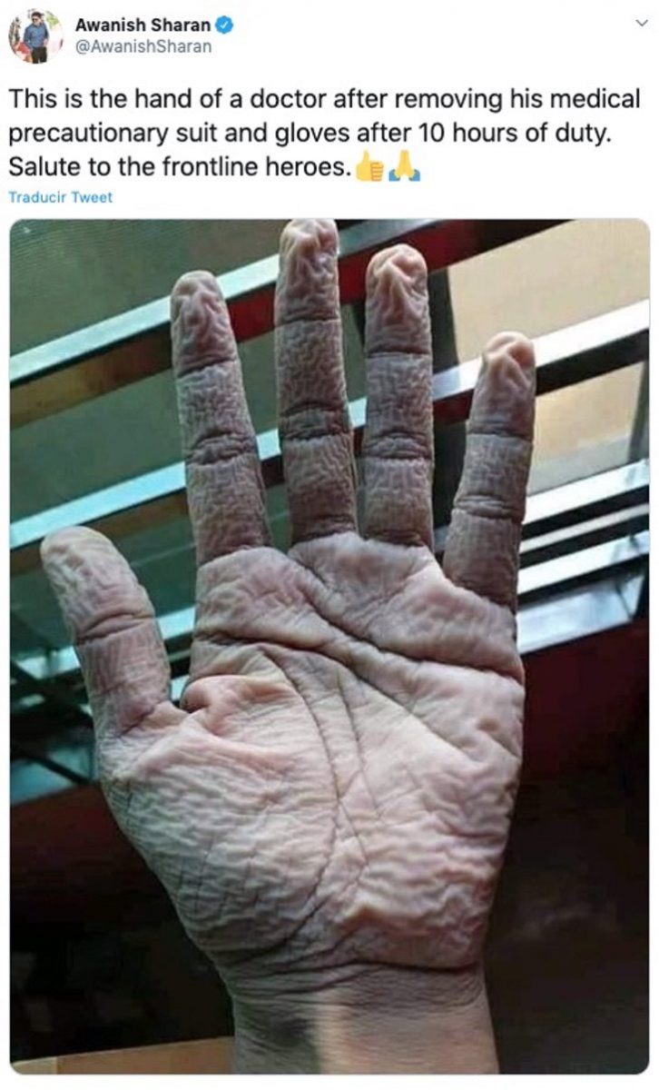 asomadetodosafetos.com - Médico choca ao mostrar a mão como sacrifício de trabalhar na linha de frente: 10 horas de luvas
