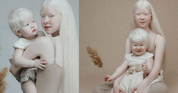 Com 12 anos de diferença, irmãs albinas surpreendem pela incrível beleza