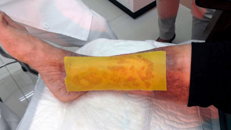 asomadetodosafetos.com - Cientistas criam adesivo de mel para diabéticos que regenera a pele em poucos dias