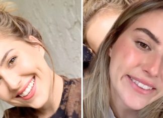 Em vídeo, mulher conta como o botox arruinou seu sorriso
