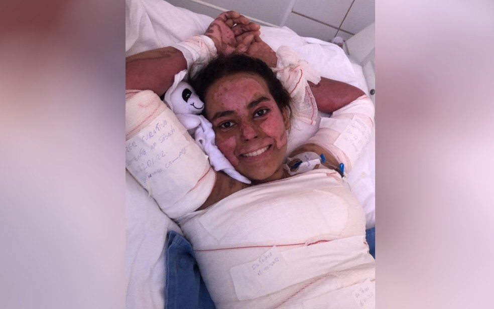 asomadetodosafetos.com - Estudante tem corpo queimado ao gravar desafio das redes sociais: "Sou um milagre"