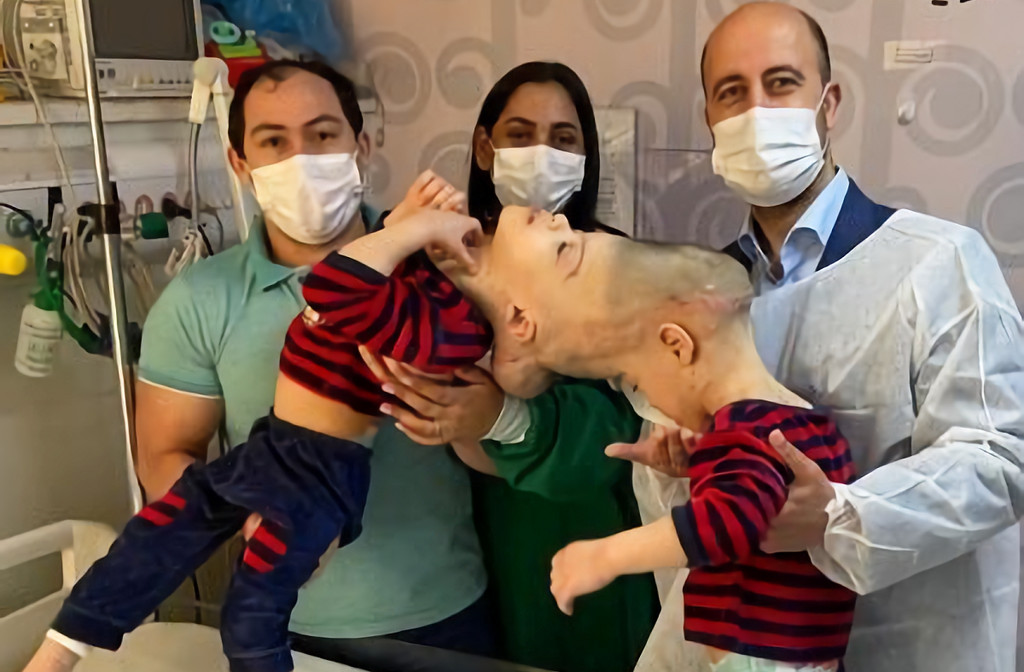 asomadetodosafetos.com - Gêmeos brasileiros unidos pelo crânio são separados com ajuda de realidade virtual
