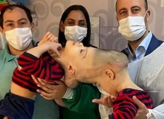 Gêmeos brasileiros unidos pelo crânio são separados com ajuda de realidade virtual