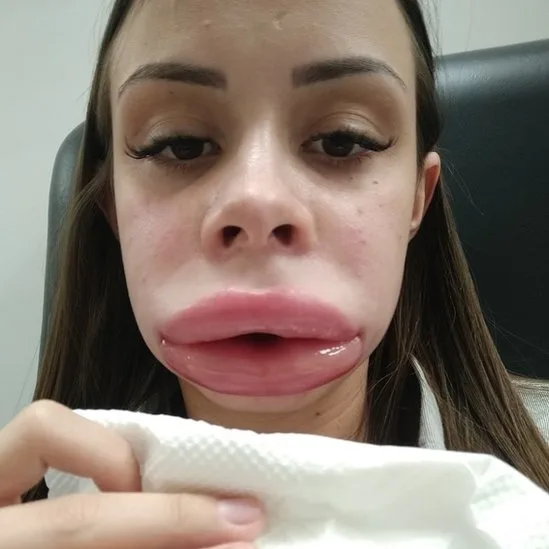 asomadetodosafetos.com - Jovem faz preenchimento labial, tem reação incomum e descobre doença rara