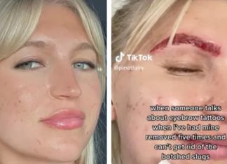 Mulher tenta remover tatuagem na sobrancelha e resultado assusta internautas