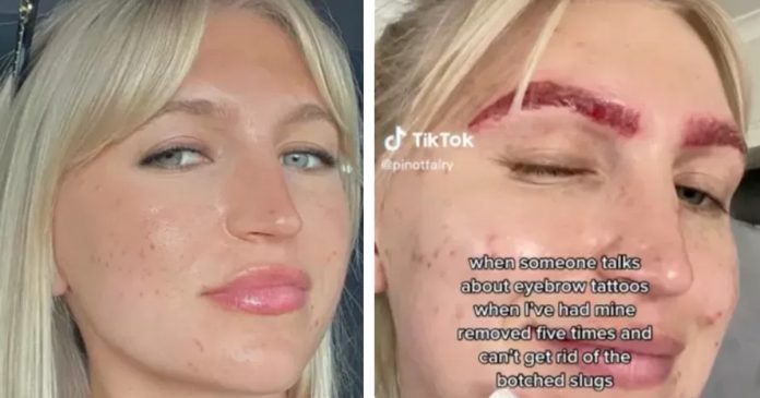 Mulher tenta remover tatuagem na sobrancelha e resultado assusta internautas