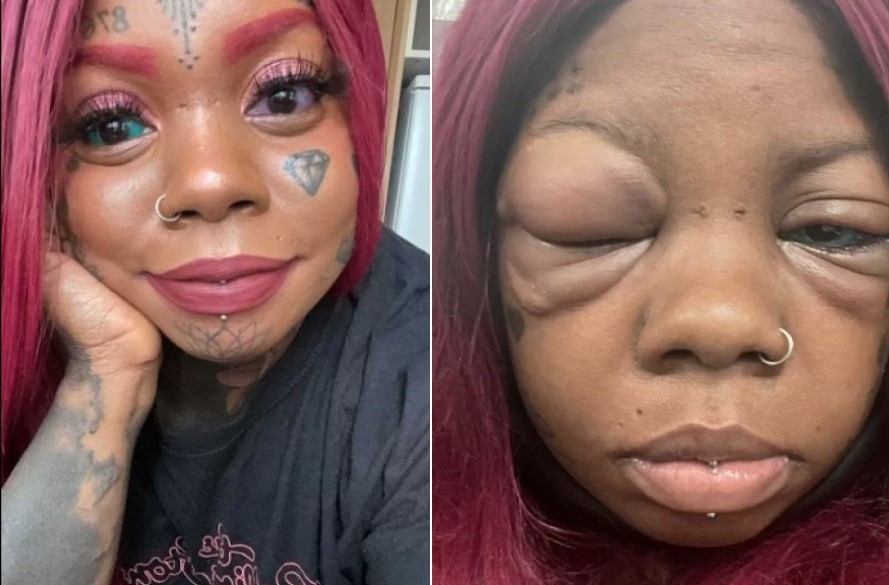 asomadetodosafetos.com - Mulher tem reação alérgica depois de tatuar globo ocular e pode ficar cega