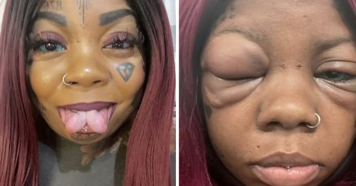 Mulher tem reação alérgica depois de tatuar globo ocular e pode ficar cega