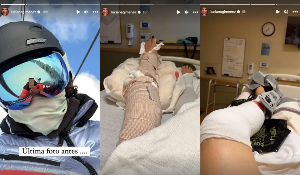 asomadetodosafetos.com - Após acidente grave na neve, Luciana Gimenez mostra como ficou sua perna
