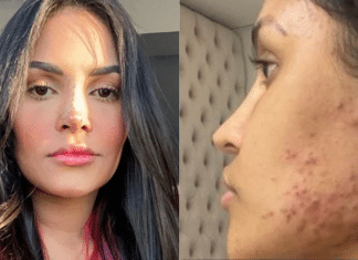 Ex-BBB Flay relata problemas com ‘chip da beleza’: “Minha pele foi minha maior tristeza”