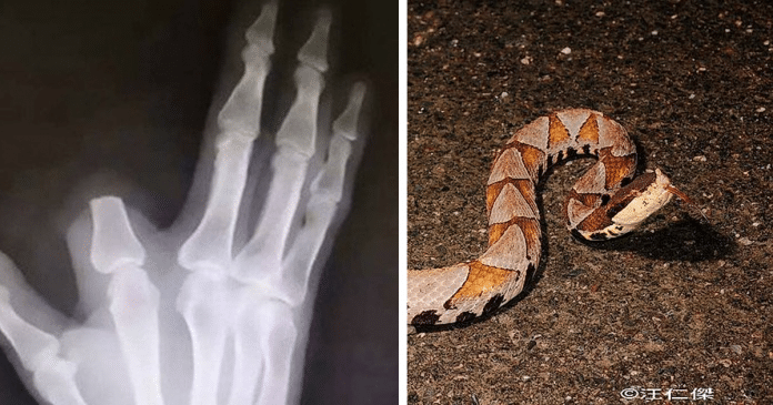 Homem picado por cobra amputa o próprio dedo, mas descobre que não precisava
