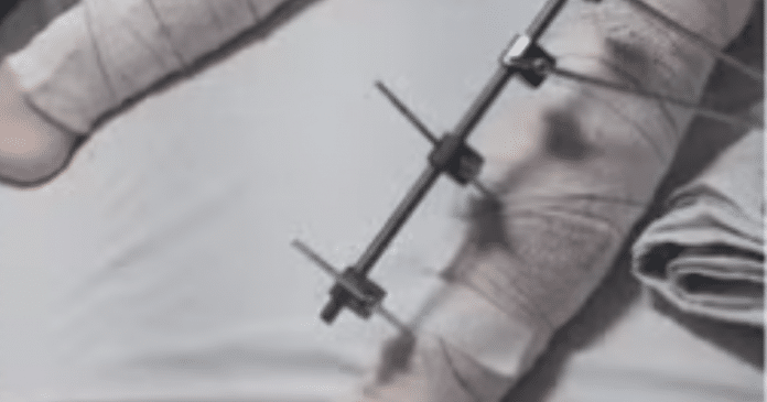 Menina de 6 anos é operada e recebe pinos em perna errada na Paraíba
