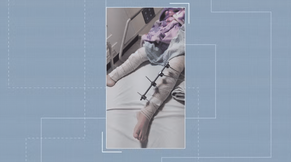 asomadetodosafetos.com - Menina de 6 anos é operada e recebe pinos em perna errada na Paraíba